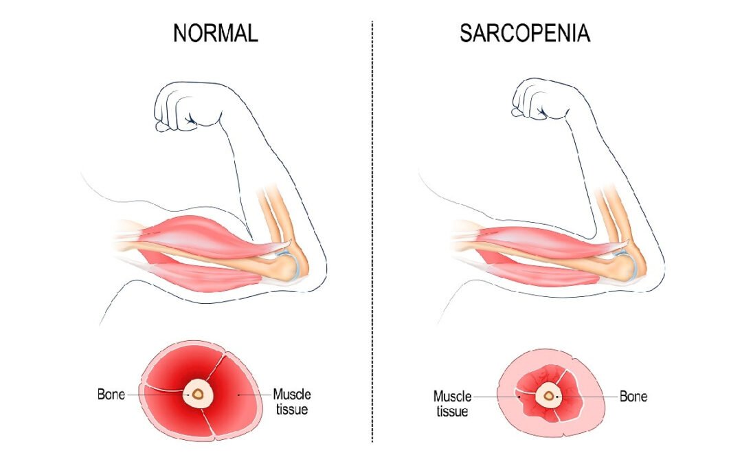 Aging and the Dangers of Sarcopenia