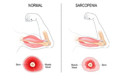 Aging and the Dangers of Sarcopenia